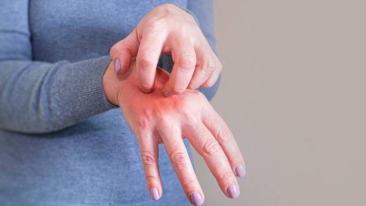 Českem se šíří epidemie svrabu. Takto poznáte první příznaky