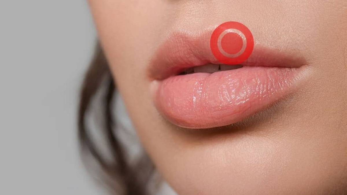 Jak vyléčit opar přes noc. Jde to snadno a nestojí to vůbec nic