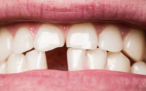 Sen o vypadávání zubů